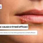 Herpes labiale: cause, rimedi efficaci e come velocizzare la guarigione