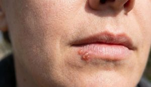 Herpes labiale cos'è