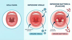 Placche in gola come riconoscerle