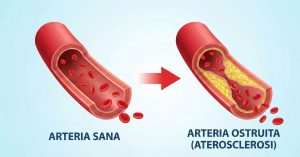 Differenza tra arteria ostruita e sana