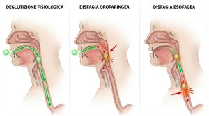 differenza tra disfagia orofaringea e esofagea differenza tra disfagia orofaringea e esofagea