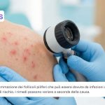 Follicolite cause e rimedi