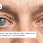 Glaucoma che cos'è e quali sono le cause