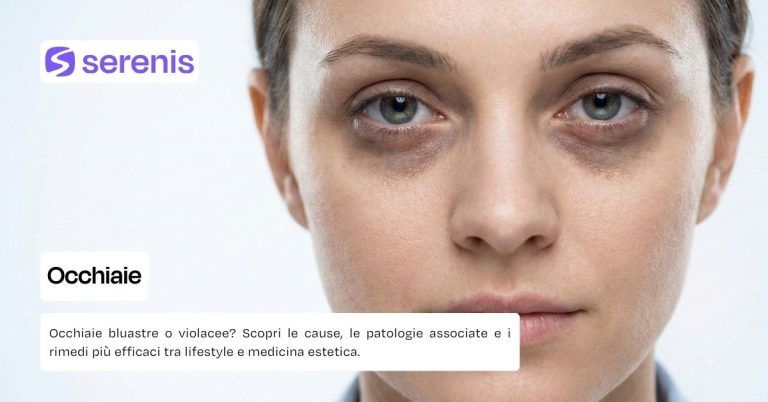 Occhiaie cause e rimedi