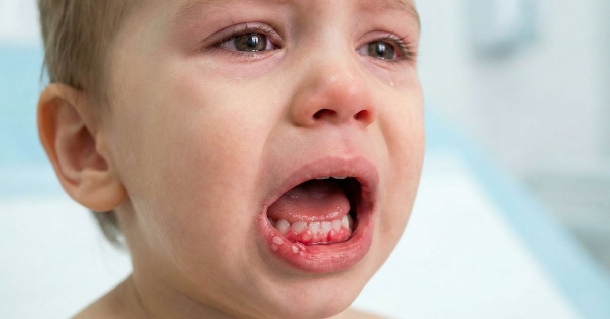 Fasi di guarigione della stomatite nel bambino dal giorno 1 al giorno 10