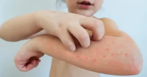 Varicella sintomi