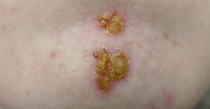 impetigine