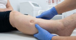 Segno della fovea linfedema