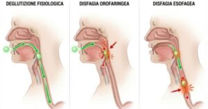 Le tipologie di disfagia
