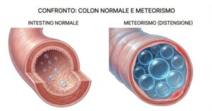 Confronto colon normale e meteorismo
