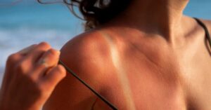 Eritema solare: sintomi