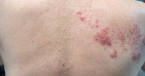 Esempio di papule da orticaria
