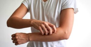 Orticaria da contatto prurito