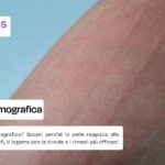 Orticaria dermografica