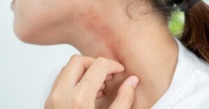 Orticaria papulosa nei bambini