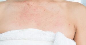 Orticaria virale pomfi