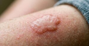 Pomfi causati dall'orticaria