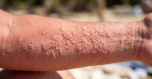 Pomfi da orticaria solare