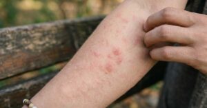 Sintomi Orticaria virale