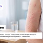 orticaria cronica cause