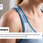orticaria-colinergica-sintomi-pelle