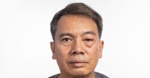 Angioedema sull'occhio