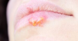 Herpes nei bambini sulle labbra