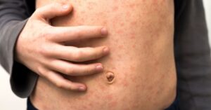 Macchie sulla pancia per il morbillo nei bambini