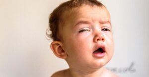Occhi chiusi e gialli per congiuntivite nei bambini