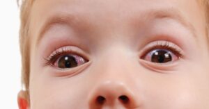 Occhi rossi per congiuntivite nei bambini