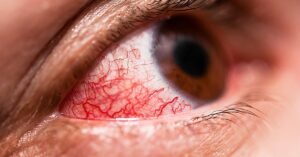 Occhio rosso per la congiuntivite