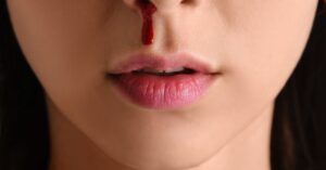 sangue dal naso, ragazza che perde sangue dal naso