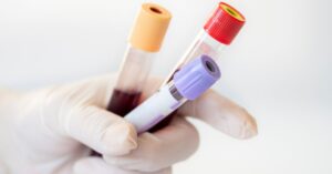 mononucleosi, esami del sangue