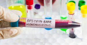 virus della mononucleosi
