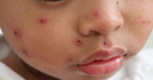 Macchie in volto per il morbillo nel bambino