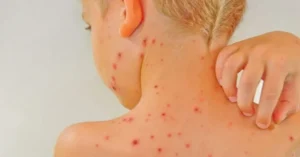 Rash da scarlattina nei bambini