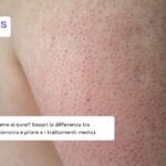 Cheratosi: scopri cos'è e come si cura