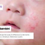 Eczema nei bambini: cause, sintomi e cura