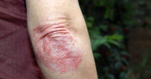 Eczema nummulare