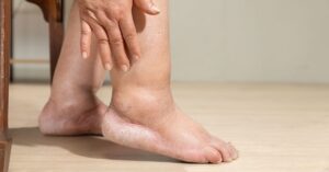Linfedema alle gambe: cos'è