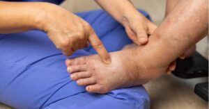 Linfedema alle gambe