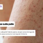 Cosa fare con le macchie rosse sulla pelle