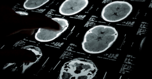 Tac con contrasto per neoplasie
