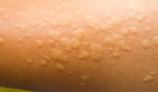 Pomfi orticaria nei bambini