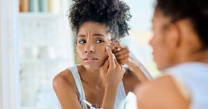 Chi colpisce l'acne in gravidanza?