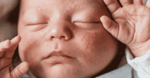 Che cos'è l'acne neonatale