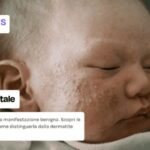 Acne neonatale: cause, quanto dura e come si cura