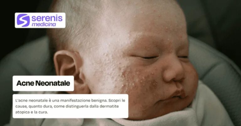 Acne neonatale: cause, quanto dura e come si cura