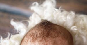 Come riconoscere la craniostenosi neonatale
