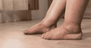 Edema osseo: cos'è